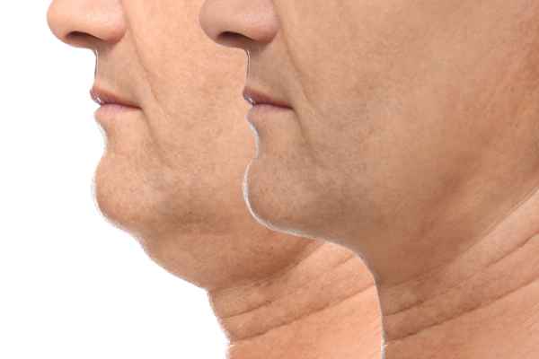 HIFU - Breakthrough in Anti - ageing 2 hifu results Knutsford