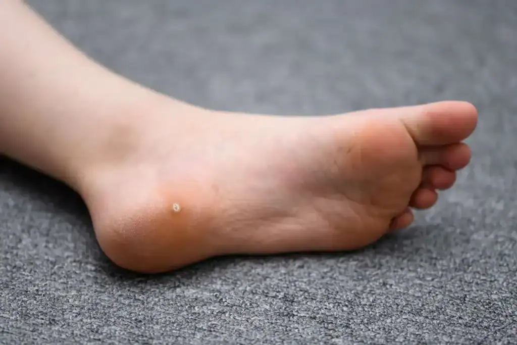 Cryotherapy For Warts And Also Verrucas 2 Image of verruca on the bottom of the foot that able to be treated with Cryotherapy Knutsford