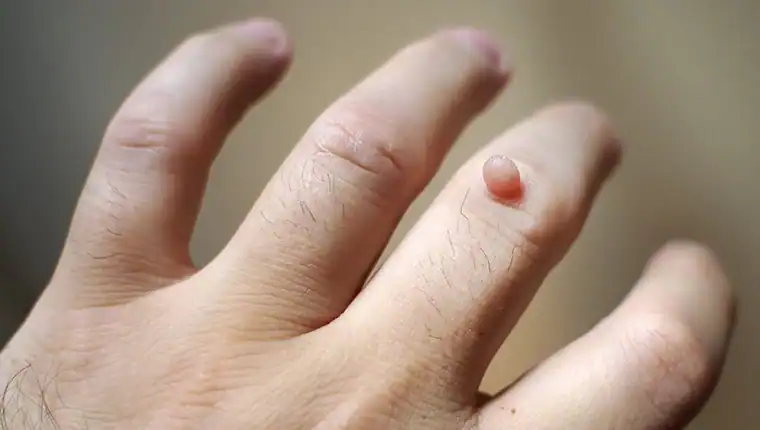 Cryotherapy For Warts And Also Verrucas 1 Image of blemish that Cryotherapy Knutsford can remove with Lipo 360.