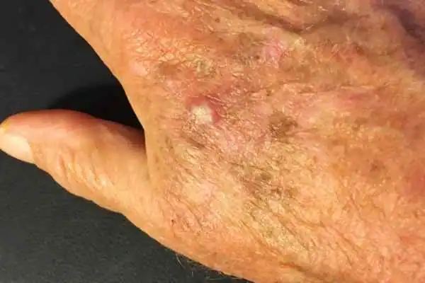 Cryopen For Actinic Keratoses 1 Image of Actinic keratoses Knutsford on a person hand