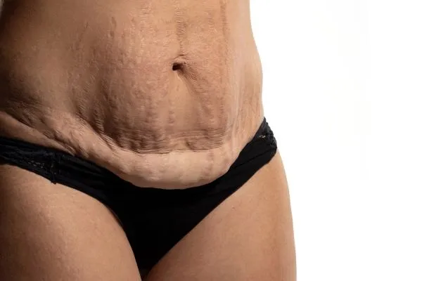 The Science of Skin Tightening 1 The science behind skin tightening Knutsford picture of a woman's sagging skin on the stomach